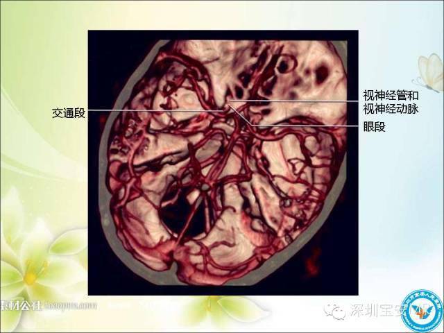 先来一段血管tof的原始图像视频,对于了解颅内动脉走形及3d很有帮助的