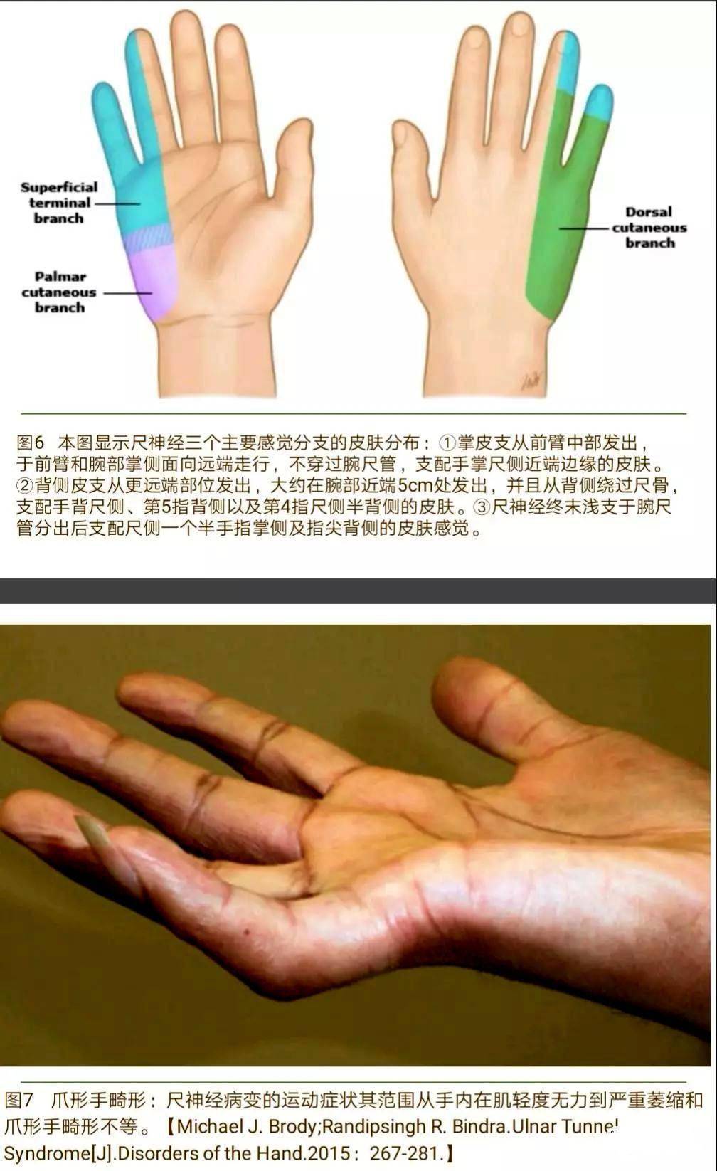 手内在肌萎缩,肌力减退,可出现爪形手畸形.1.
