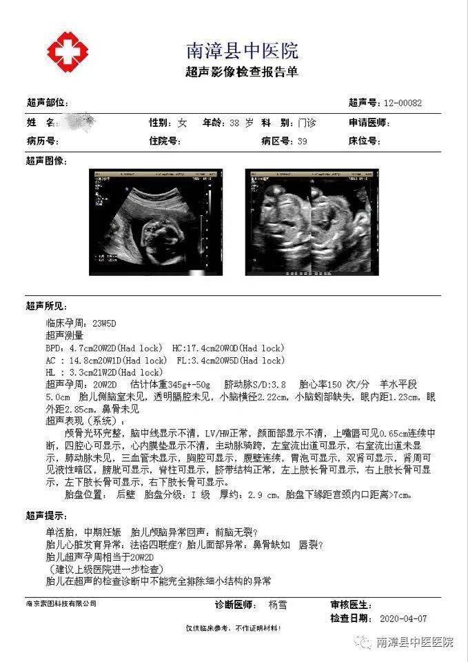 (全前脑畸形(holoprosencephaly)也称前脑无裂畸形,是前脑发育障碍