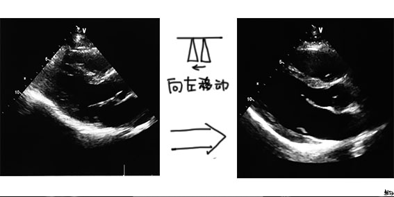 心尖图文详解 | 心超切面不会打？看这一篇就够了！