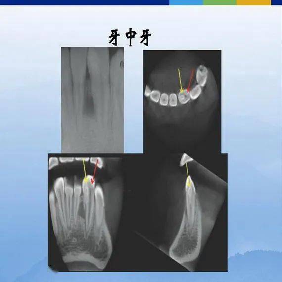 牙体牙周正常解剖及常见病x线表现