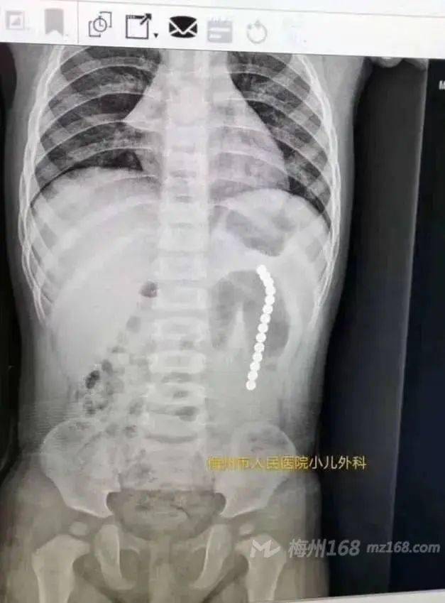 五华一名2岁儿童误吞磁力珠致胃肠穿孔！梅州今年已有三起！ 