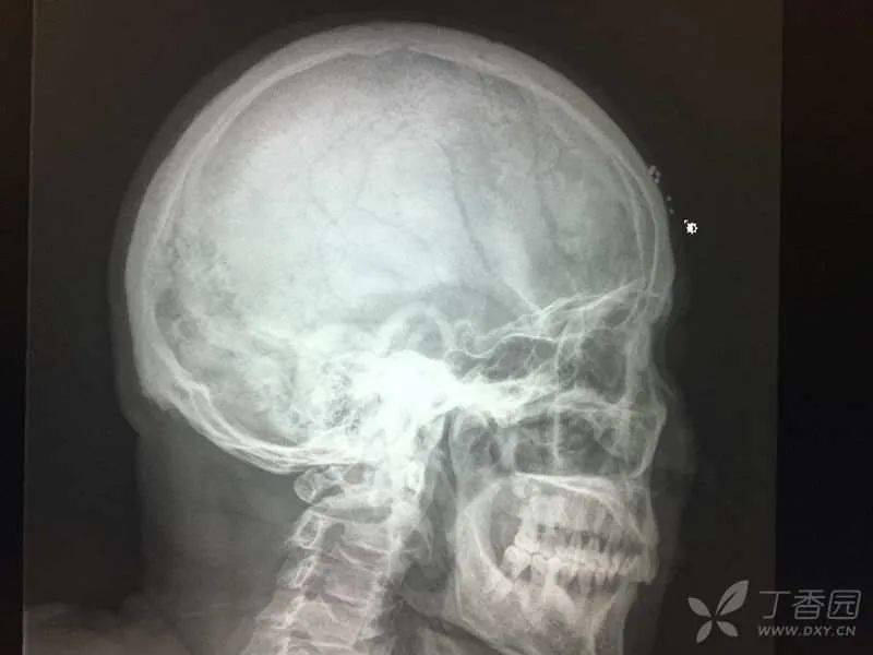 (图 4 头颅正侧位片 既往就医(普外科 2016 年 2 月患者因「腹胀