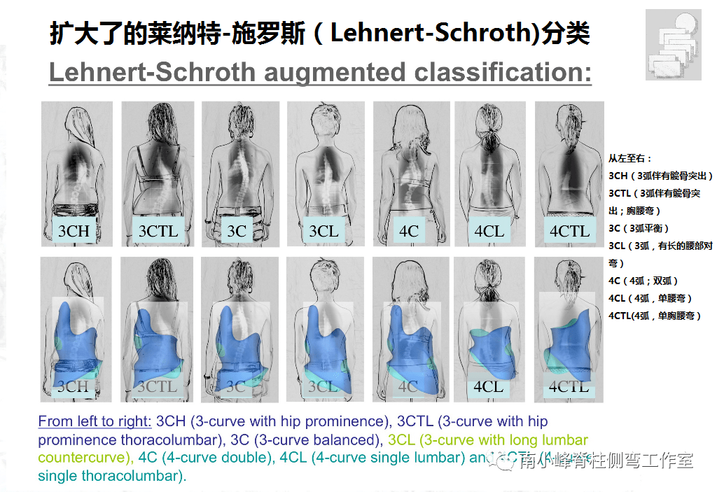 剃刀|孩子脊柱侧弯后引起的“剃刀背”如何矫正？