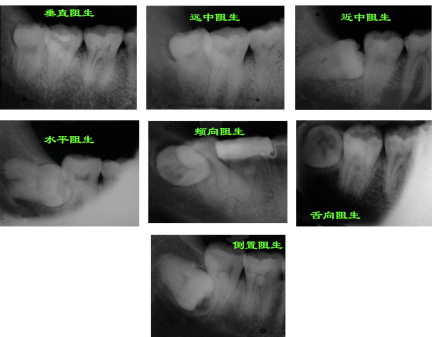 天后|男子拔完智齿流血不止，10多天后离世……一检测血液里全是细菌