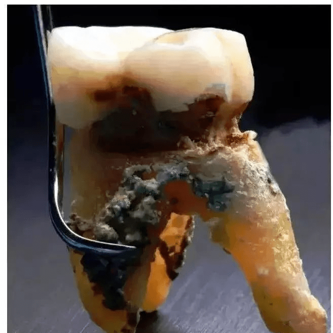 多年不洗牙,牙结石堆成钟乳石!是时候放下对洗牙的偏见了!