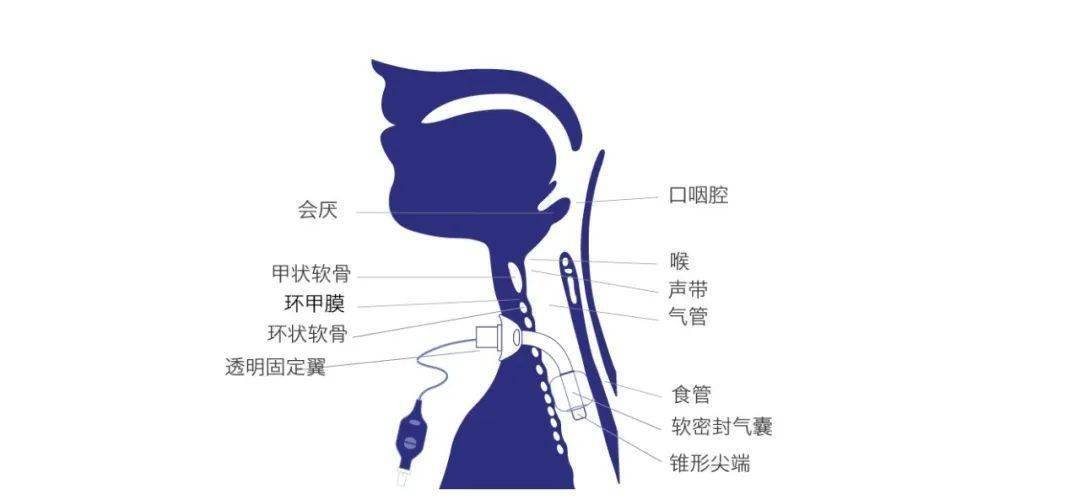 气囊位置:气管插管,气切套管和喉罩上的气囊位置