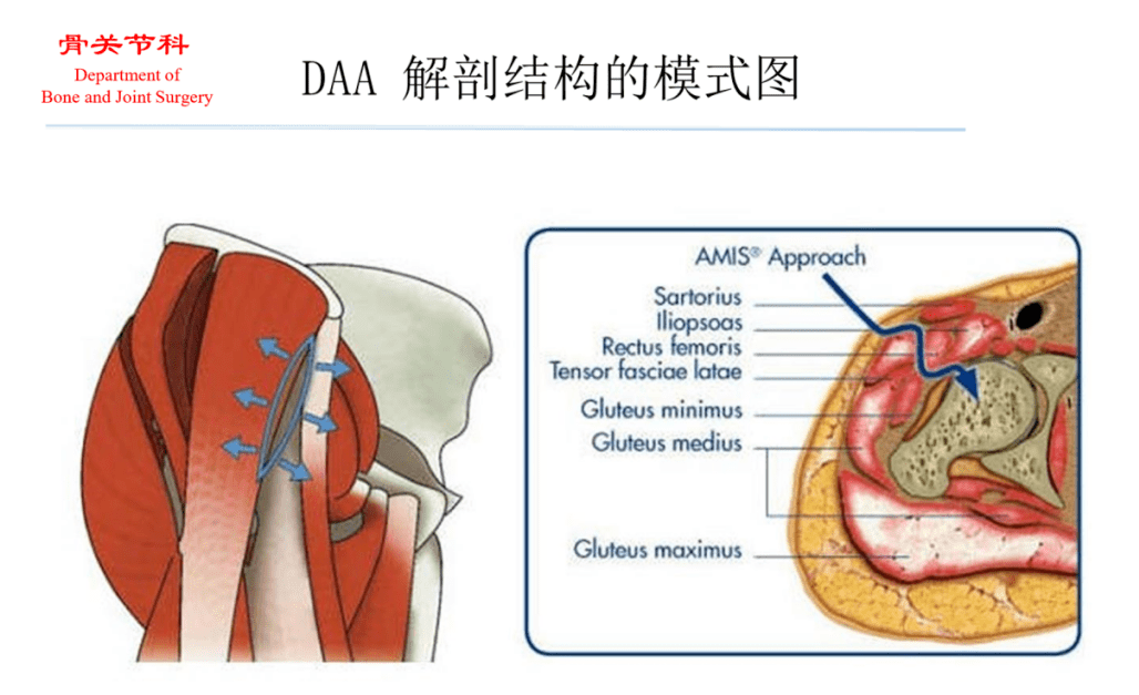 学术动态 | 李广恒《髋关节前入路daa手术的关键技术》直播回顾