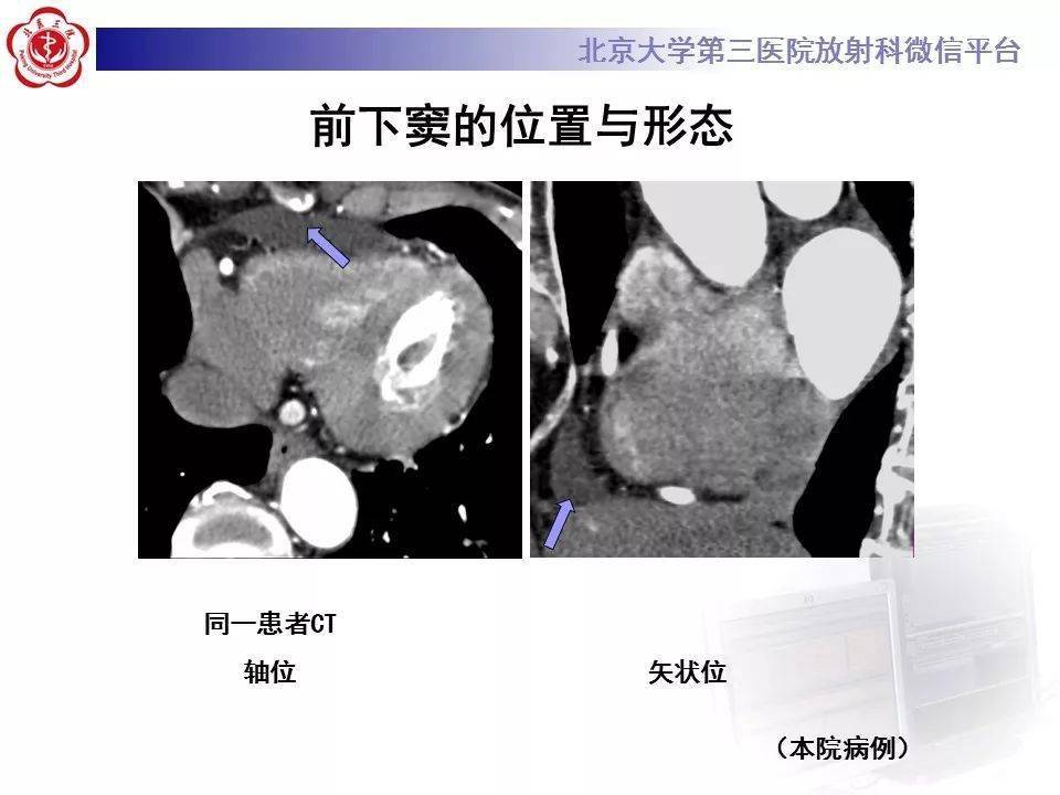 影像精美解剖丨心包窦及心包隐窝解剖建议收藏