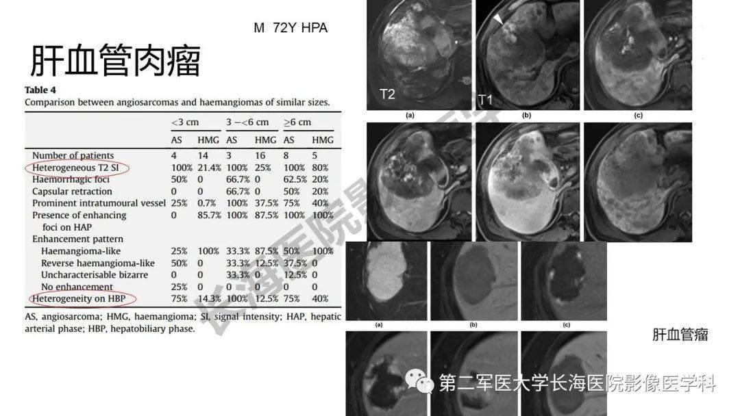 肝脏血管肉瘤影像表现