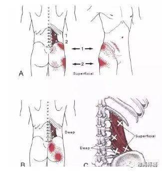 腰痛之第三腰椎横突综合症