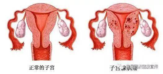 子宫肌瘤早期症状都有哪些?