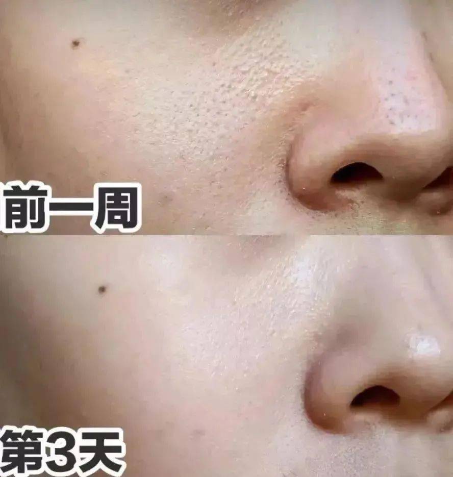 吸铁石|新西兰百年历史“污垢吸铁石”,15分钟告别黑头、粉刺、闭口!