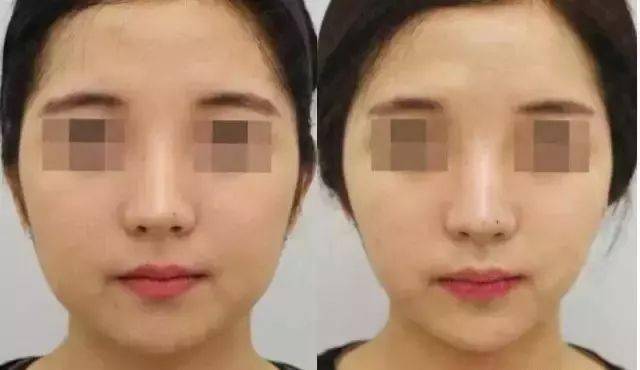 效果|这个比瘦脸针还好用的好物，既消水肿又提拉紧致，立变小V脸！