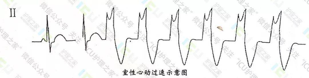 心电图这样读图,没有不会的!