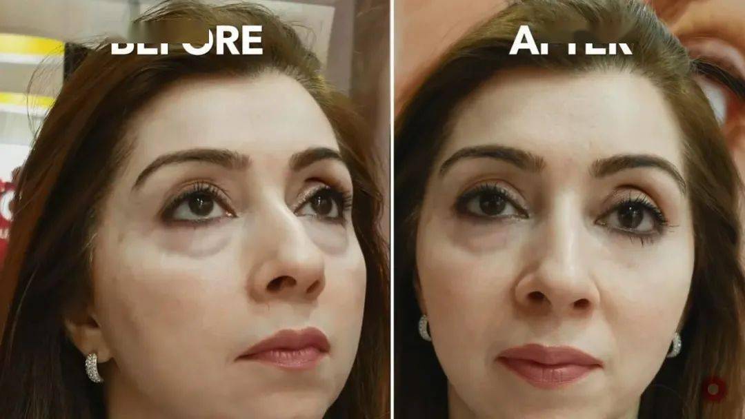 效果|震撼黑科技！搞定眼袋、细纹、浮肿、黑眼圈……效果比PS还好！