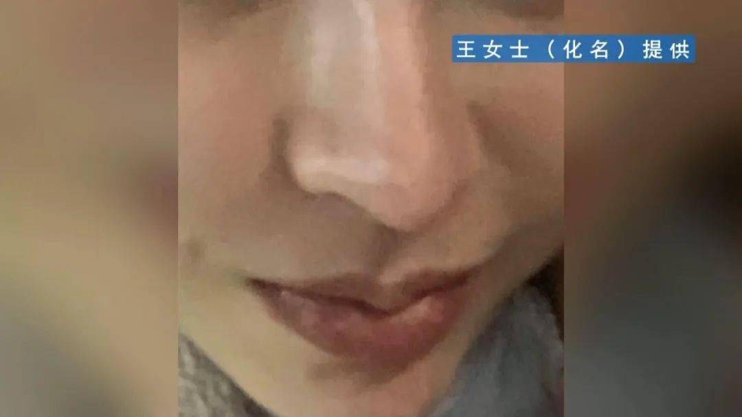 伤口|慎点！女子隆鼻手术后，伤口反复流出脓液！结果…