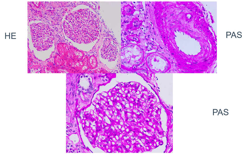 治疗|ARNI，心肾综合征治疗的新希望?