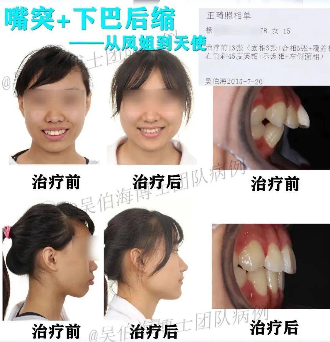 23岁的李女士原本是骨性 地包天