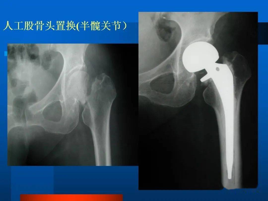 专业分享·X光片解读：股骨颈变形；髋关节间隙变窄，边缘骨质增生硬化改变_股骨头
