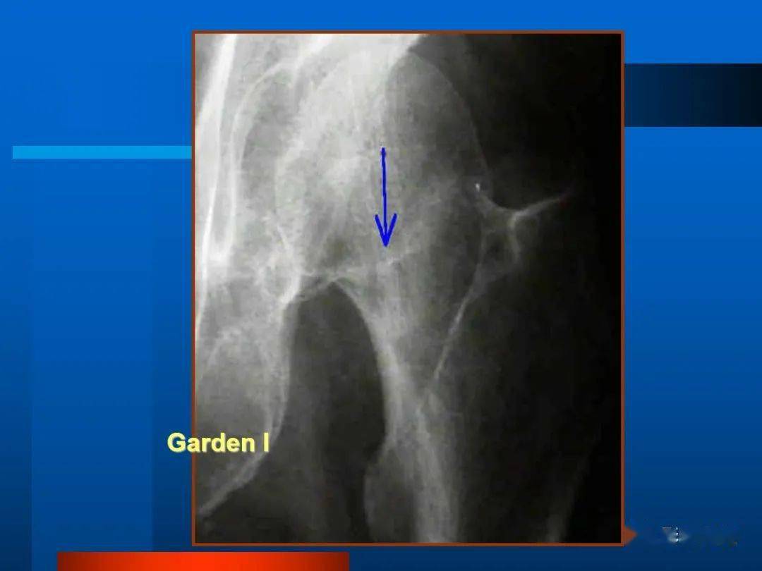股骨颈骨折影像表现