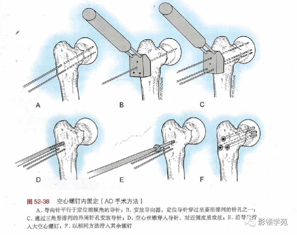 股骨颈骨折影像表现