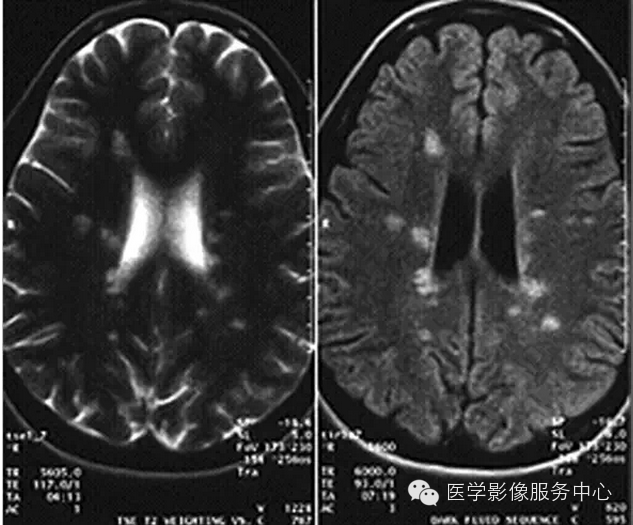 脱髓鞘脑病影像诊断_白质