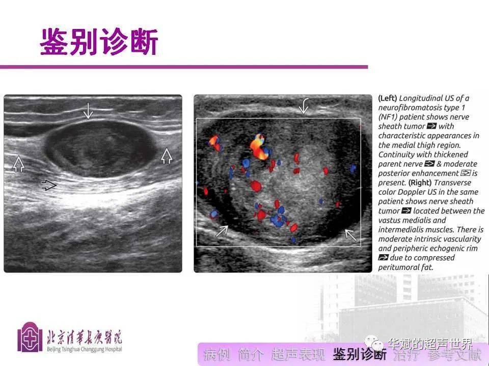 病例和文献阅读:颈部神经鞘瘤