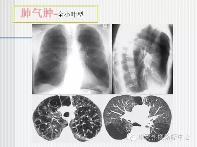 天天说的肺气肿,分型是怎么分的呢