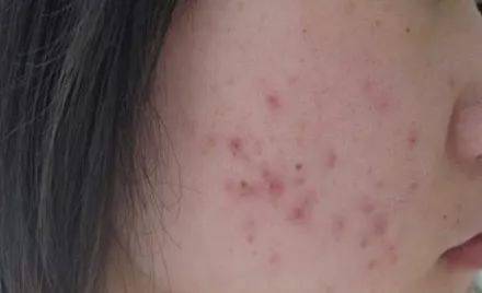 救星|这款PS级的“烂脸救星”，让我抛弃了SKII的“前男友面膜”！