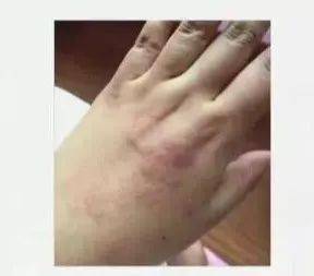 什么叫单纯疱疹和带状疱疹 0441edd33e3b40fe936e291e4af09e03.jpeg