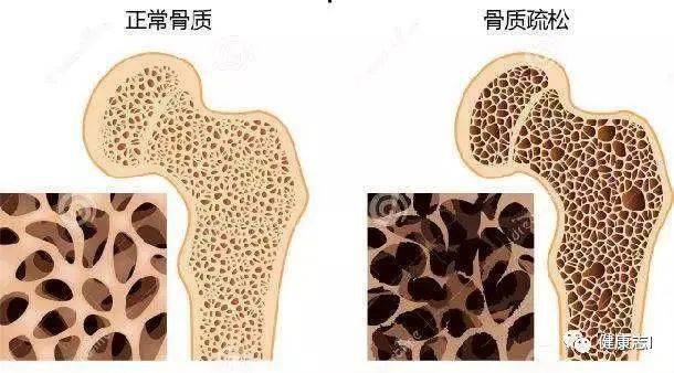 超过90%的骨质疏松症患者,不知道自己患病,12类人更要当心