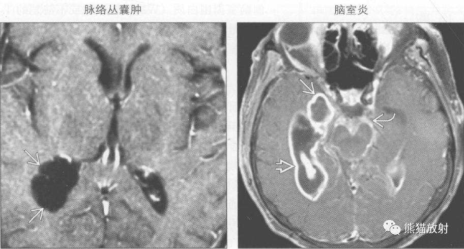 胎儿脑室不对称怎么办