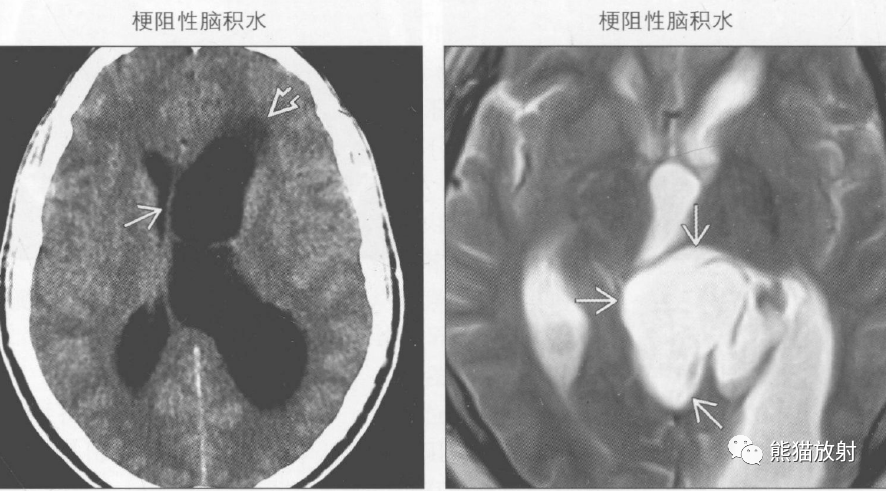 胎儿脑室不对称怎么办