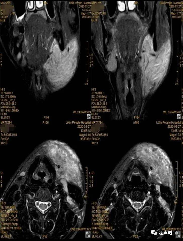 经典病例分享不一样的颌下区肿块