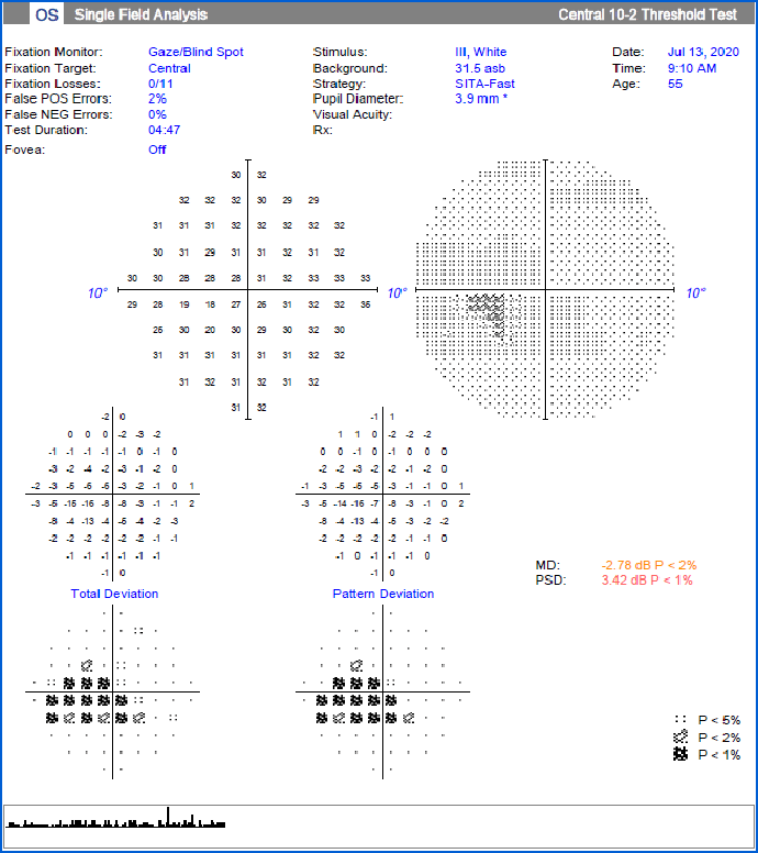 humphrey 10-2 静态视野检查30-2中心视野检查示:双眼明显的中心暗点