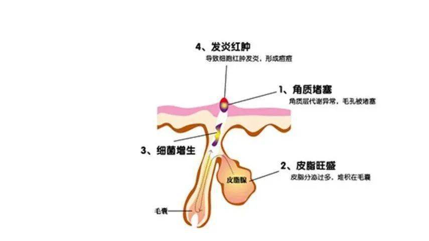 注意,这里涉及到毛囊皮脂腺单位以及慢性炎症.