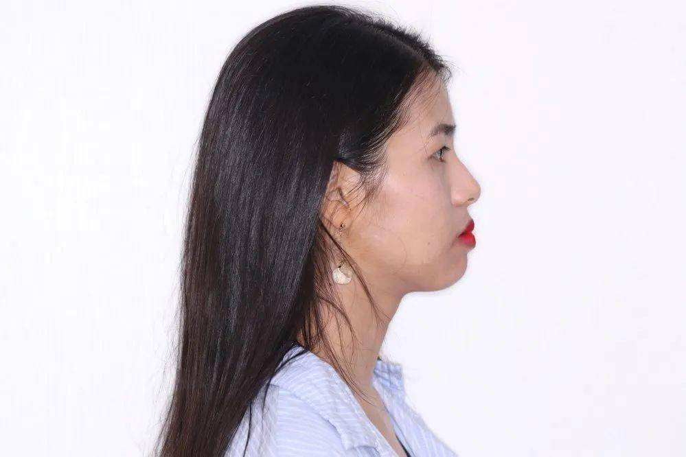 龅牙|广州95后女生从小龅牙，嘴巴都快闭不上！朋友却劝她不要矫牙，一年后......