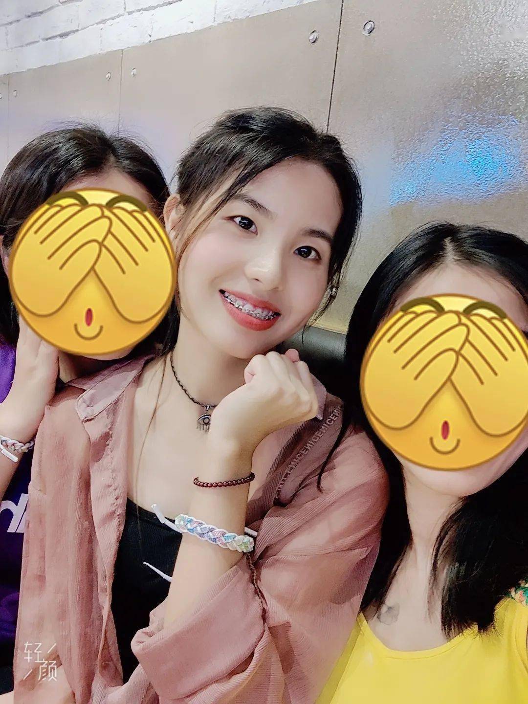 龅牙|广州95后女生从小龅牙，嘴巴都快闭不上！朋友却劝她不要矫牙，一年后......