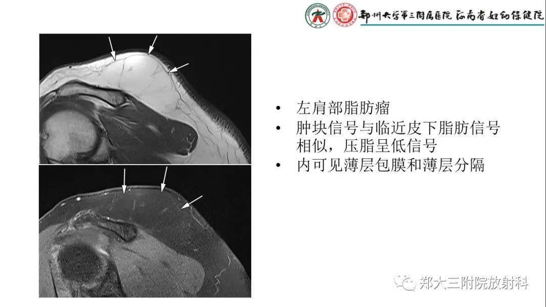 脂肪母细胞瘤的影像诊断