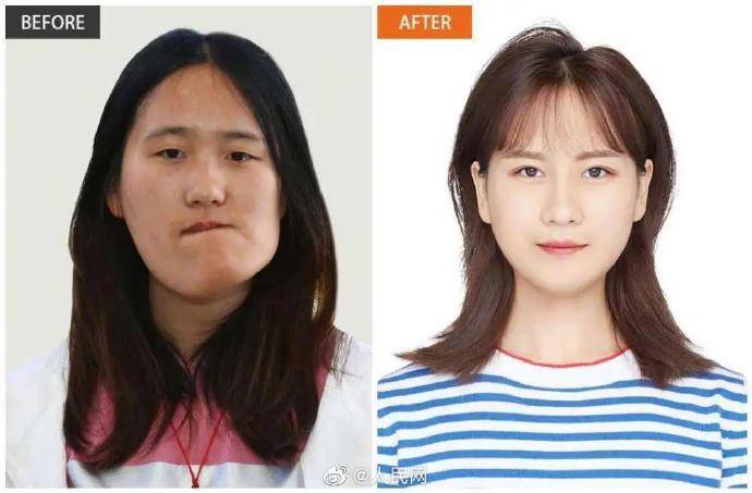 小秋|歪脸女孩手术后要回山里当老师