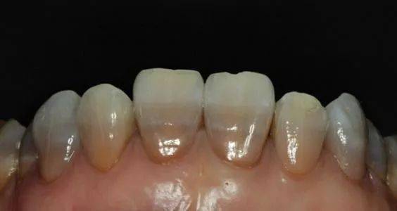 什么是四环素牙,四环素牙应该如何治疗?