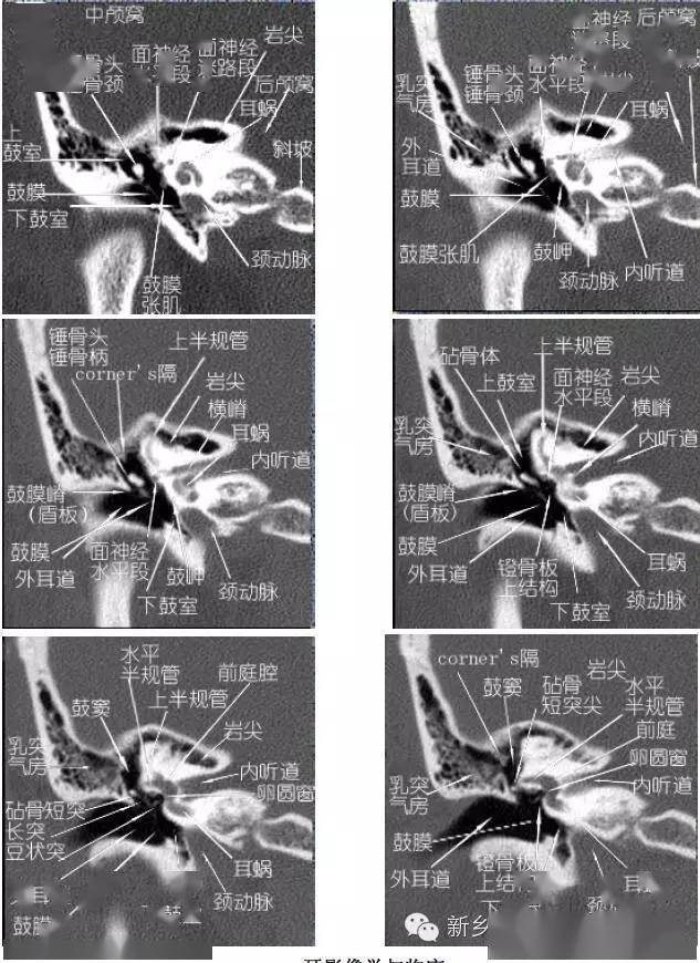 详细的颞部横断位,冠状位解剖 详细标注