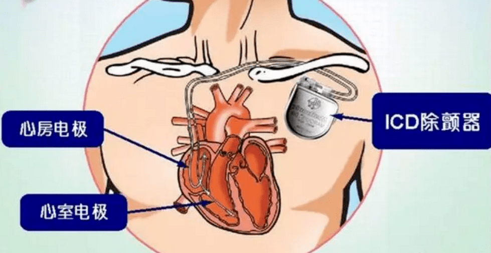 谢园|61岁演员谢园突发心脏病去世！猝死到底能不能防？
