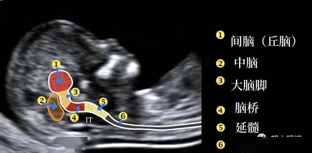 对胎儿早孕期颅脑结构要有详细准确理解