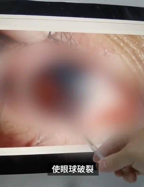 红枣|保温杯突然爆炸，女孩眼球破裂！只因泡了这个忘记喝......