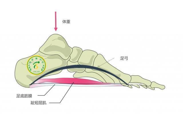 足底筋膜炎行走的疼痛