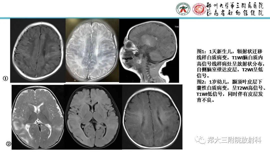 【zdzt100】新生儿及婴儿结节性硬化症的影像学表现