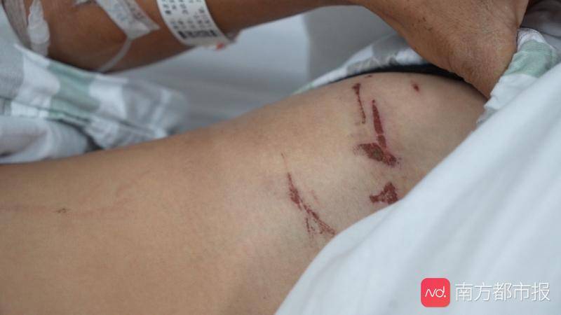 雷电|雷击突出物，打伞、高空作业都很“突出“两男子因雷击进急诊