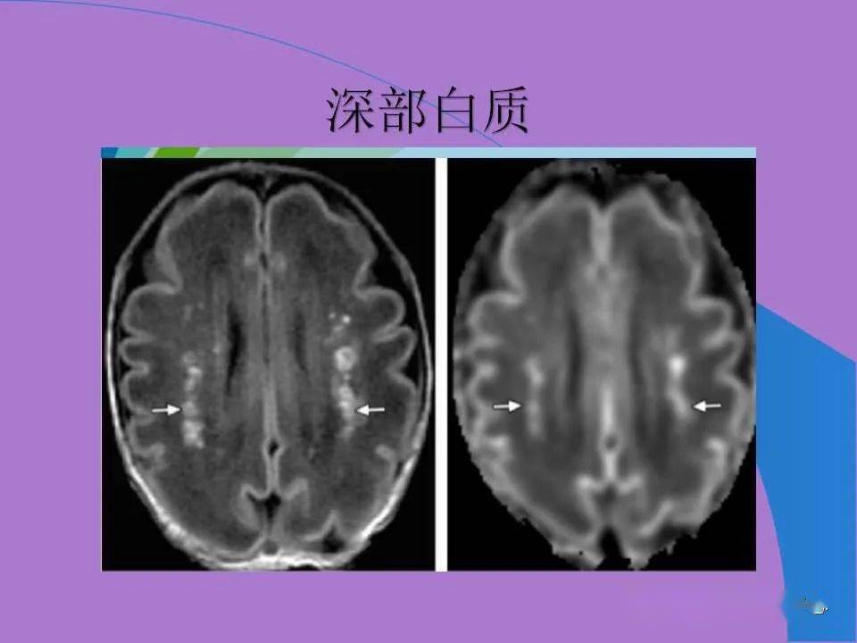 什么是缺血性脑出血 d599bf3dd1d04afba40d1ded55f5e647.jpeg